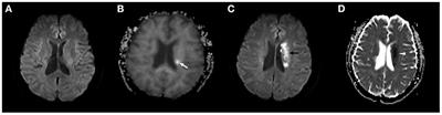 Diffusion kurtosis imaging in patients with tissue-negative transient ischemic attack